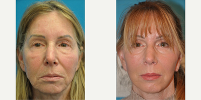Woman treated with SMAS Facelift - Woman treated with Deep Plane Facelift, SMAS Facelift, and the subcutaneous layer to correct nasolabial folds, marionette lines, jowling, and the general sagging of the midface to lower-face tissues.