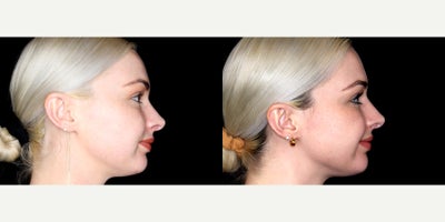27 year old woman treated with Thread Lift - 27 year old woman treated with Thread Lift. Photos depict before and 1 month after 10 novathreads.