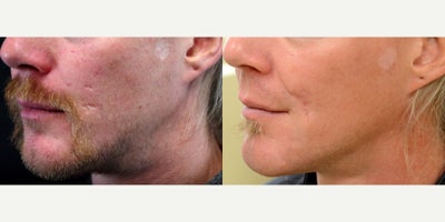 37 year old man treated with Scar Removal - 37 year old man treated with Scar Removal. Photos depict before and 2.5 months after treatment.