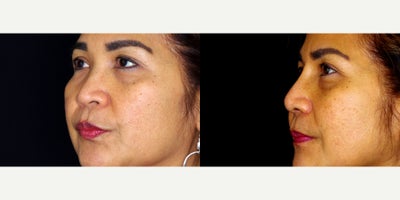 57 year old woman treated with Asian Rhinoplasty. P - 57 year old woman treated with Asian Rhinoplasty. Photos depict before and 3 months after surgery.