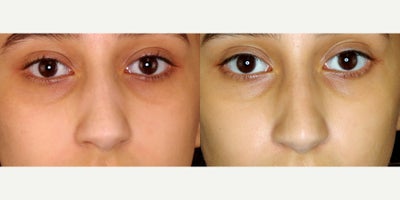 21 year old woman treated with Restylane Lyft - 21 year old woman treated with Restylane Lyft. Photos depict before and 1 month after 1 syringe was injected to her nose (liquid rhinoplasty)