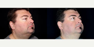 52 year old man treated with IPL - 52 year old man treated with IPL for Rosacea