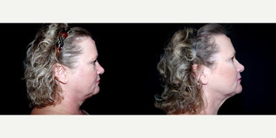 58 year old woman treated with Thread Lift - 58 year old woman treated with Thread Lift. Photos depict before and 3 months after 6 Instalift Sutures