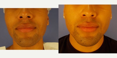 25-34 year old man treated with AccuTite - AccuTite Jowls