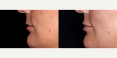 24year old woman treated with Volbella - 24 year old woman treated with Volbella, Lip Fillers. Photos depict before and 1 month after treatment.