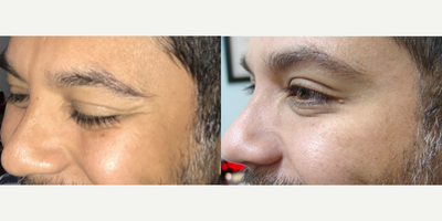 35-44 year old man treated with Botox - 41 year old male 3 weeks after Botox treatment to crows feet. 15 units of Botox was administered to patients crows feet in the Med Spa.