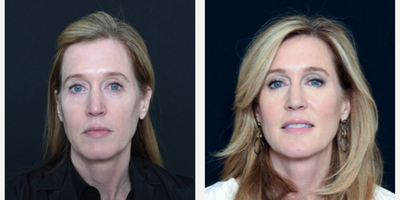 Woman treated with Bellafill - Woman treated with Bellafill
