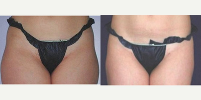 35-44 year old woman treated with UltraShape - Results after three pain free treatments with Ultrashape.