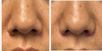 25-34 year old woman treated with Alarplasty - 28 year old female treated with alarplasty under local anesthesia.