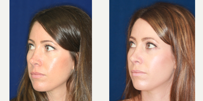 25-34 year old woman treated with Nonsurgical Nose Job, Silicone Injections, Silikon 1000 - Permanent Non- surgical Revision Rhinoplasty after overdone surgery. Bridge raised by gradual filling, particularly just above the tip. Refashioning the pinched, overdone tip.