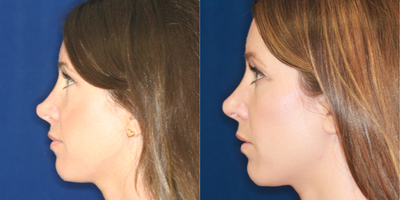 25-34 year old woman treated with Nonsurgical Nose Job, Silicone Injections, Silikon 1000 - Permanent Non- surgical Revision Rhinoplasty after overdone surgery. Bridge raised by gradual filling, particularly just above the tip. Refashioning the pinched, overdone tip.