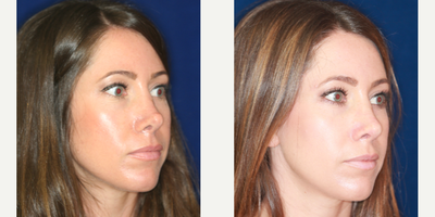 25-34 year old woman treated with Nonsurgical Nose Job, Silicone Injections, Silikon 1000 - Permanent Non- surgical Revision Rhinoplasty after overdone surgery. Bridge raised by gradual filling, particularly just above the tip. Refashioning the pinched, overdone tip.