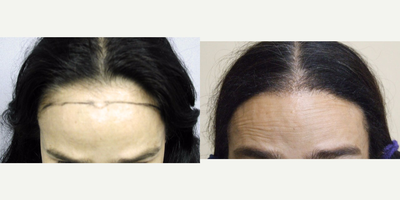 45-54 year old woman treated with Forehead Reduction with Hair Transplant to lower and round out the corners - Forehead Reduction with Hair Transplant to lower and round out the corners.