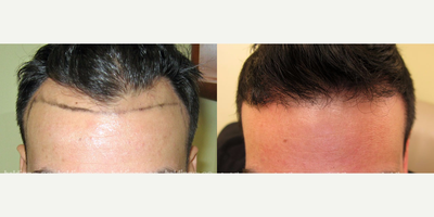 25-34 year old man treated with Forehead Reduction with Hair Transplant - Forehead Reduction with Hair Transplant