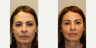 Woman treated with Brow Lift - Woman treated with Brow Lift