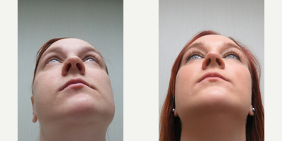 25-34 year old woman treated with Rhinoplasty - This patient underwent a Rhinoplasty
