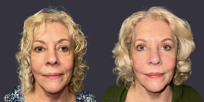 65-74 year old woman treated with ActiveFX, CO2 Laser, Eyelid Surgery, Laser Resurfacing - This 70 year had an upper and lower eyelid blepharoplasty surgery including CO2 laser resurfacing around the eyes. She is 5'6 tall and weighs 195 pounds. Her results are shown 6 months after surgery.