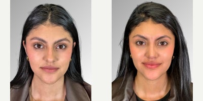 18-24 year old woman treated with Facial - Our patient underwent ultrasonic rhinoplasty for a nose with thick skin, a bulbous tip, dorsal hump, asymmetry, deviation, and a high radix. The procedure allowed us to create a more refined, balanced, and harmonious nasal shape while preserving natural facial proportions. Months later, we complemented her result with CO2 laser skin treatment an ideal addition, as optimizing skin quality is essential to achieving even more beautiful and polished outcomes.