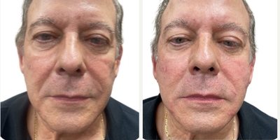 Man treated with Renuva - Renuva is a bio-compatible, extracellular matrix that contains the same growth factors, proteins, and collagens found in your own fat.Renuva is an ideal alternative to small-volume fat grafting, because it does not require liposuction to harvest the patients own fat, and has no downtime.When injected, Renuva creates a honeycomb-like matrix that is then filled with the bodys own fat. Over the course of three to six months post-treatment the Renuva matrix is slowly eliminated by the body  leaving only the patients own fat, exactly where they want it!
