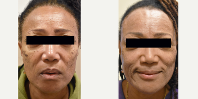 African American skin laser resurfacing.  Laser resurfacing for dark skin. - If you thought you were not a candidate for laser resurfacing because you have dark skin, think again.  With 20 years of laser experience, we can treat all skin types.