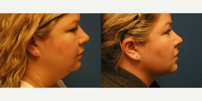 Woman treated with Chin Liposuction - Woman treated with Chin Liposuction