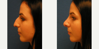 Woman treated with Rhinoplasty - Woman treated with Rhinoplasty to reduce dorsal hump
