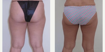 Woman treated with Vaser Liposuction - Woman treated with Vaser Liposuction