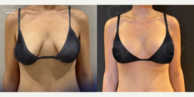 45-54 year old woman treated with Breast Lift - A breast lift, or mastopexy, is a surgical procedure designed to raise and reshape sagging breasts by removing excess skin and tightening the surrounding tissue.