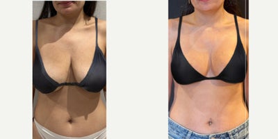 55-64 year old woman treated with Breast Reduction - 55-64 year old woman treated with Breast Reduction