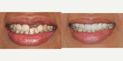25-34 year old woman treated with Tooth Repair - Cosmetic Dentistry using Emax crown/bridge