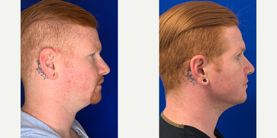 25-34 year old man treated with Chin Liposuction - 3 weeks after submental liposuction