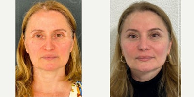 55-64 year old woman treated with Facelift, Lower Facelift, Mini Facelift - 55-64 year old woman treated with Facelift, Lower Facelift, Mini Facelift