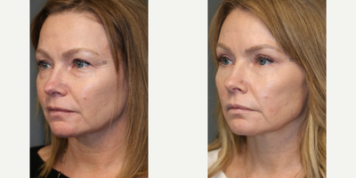 Upper and Lower Eyelid Surgery - Upper and lower eyelid surgery with laser.