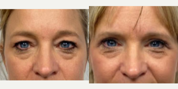 55-64 year old woman treated with Eyelid Surgery - One month after a blepharoplasty