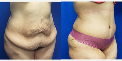 35-44 year old woman treated with Tummy Tuck - 38 year old female who is 3 months after a tummy tuck. This is her first surgery as part of her mommy makeover. She had a gastric sleeve in 2013 and lost 70 lbs. She was concerned about the loose skin and stretch marks. She has 3 children. Her preoperative height was 5 feet and 1 inch and her weight was 167 lbs. Her weight at the time of the photo was 158 lbs.