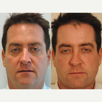 Sculptra - Before and after Sculptra injections for the cheeks and Restylane under the eyes