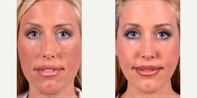 Woman treated with Cheek Implant - Woman treated with Cheek Implant