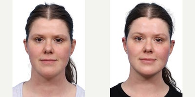 Woman treated with Skin Tightening with XERF - Woman treated with Skin Tightening with XERF