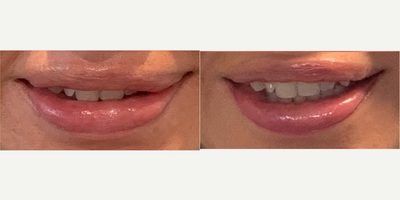 35-44 year old woman treated with Lip Reduction - 44-year-old transgender woman treated Upper Lip ReductionHeight: 52 Weight: 120 pounds BMI: 21.9 Time After Surgery: 1 WeekGoals: correct asymmetry of the upper lip after silicone injection removal