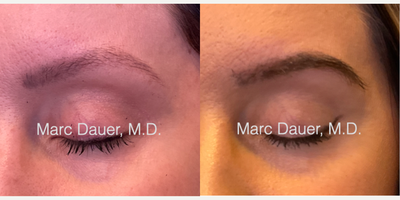 Woman treated with Eyebrow Transplant - Woman treated with Eyebrow Transplant