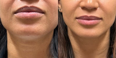 25-34 year old woman treated with Kybella - 25-34 year old woman treated with Kybella