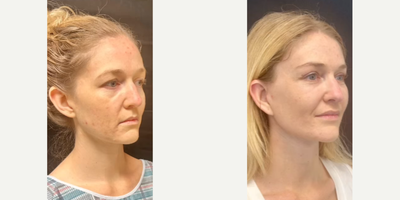 Woman treated with Neck Lift - Woman treated with Deep Plane Facelift, Neck Lift, and Brow Lift. Patient is shown before and 7 weeks post-op.