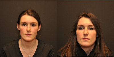 25-34 year old woman treated with Voluma - Patient was treated with Voluma to the cheeks.