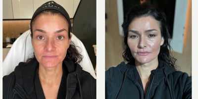 FILLER 'N THREADS COMBO - Our patient works in the industry so she would like to look her absolute best. She has noticed some signs of aging on her face, such as loss of volume in her mid face and prominent nasolabial folds. To correct this, we sculpted her face with filler as well as used threads- to give her a complete facial rejuvenation. We were able to define and sculpt her mid face leaving her cheeks contoured. We also gave her lips some natural looking plumpness, her chin that desired heart shaped look, and we didn't forget about defining her jaw for a snatched neck. All in all, she cannot believe how amazing she looks and is in love with her results!