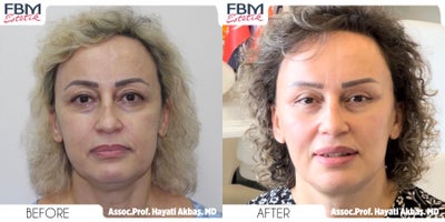 45-54 year old treated with Deep Plane Facelift, Double Eyelid Surgery, Lower Facelift, Facial Fat Transfer - 45-54 year old treated with Deep Plane Facelift, Double Eyelid Surgery, Lower Facelift, Facial Fat Transfer 9 months post operation