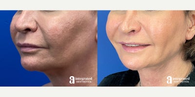 55-64 year old woman treated with AccuTite - This patient is a 56-year-old female who had concerns with her lower face and neck. Dr. Cho performed MyEllevate and accutite. After photos are 3 months post procedure.
