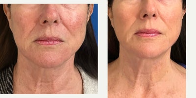 65-74 year old woman treated with RHA Collection Fillers - PDO Miracu & Mint Lift Threadlift: Facial Contouring with Fillers: RHA, Radiesse and Restylane- 65 year old female with loss of facial fat causing a flat cheek, & loss of jawline contour. Using a combination of PDO Threads: Miracu & Mint Threads and facial fillers the cheek was and Jawline was enhanced yielding a natural and rejuvenated appearance.