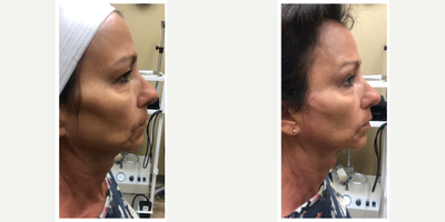 55-64 year old woman treated with Radiesse - Patient treated with Radiesse to help fill out face after weight loss