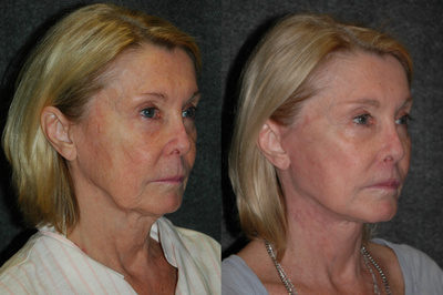 Lip Repositioning - Lip Lift + Deep Plane Facelift