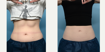 25-34 year old woman treated with Cryolipolysis - Looking for overall reduction of fat around her mid-section, this 27-year-old patient was treated with 2 CoolSculpting sessions for the lower abdomen and flanks, and 1 session for the upper abdomen. She is thrilled with the results.